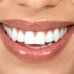 Emax Veneers