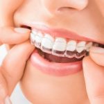 Invisalign Treatment